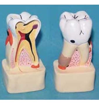 牙齿解剖剖面模型 牙齿模型 牙齿综合病理演示