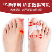 大脚趾分趾器拇指外翻矫正器姆外翻分离矫形器男女士成人可以穿鞋