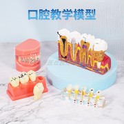 牙齿模型口腔标准牙模可拆卸窝沟封闭牙神经模型医患沟通教学模具
