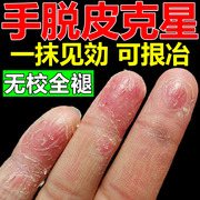剥脱性角质松懈症治疗严重手，脱皮儿童手指手心，干燥干裂的专用药膏