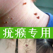干扰素凝胶跖疣扁平疣激光，去尖锐湿疣除专用治疗仪非药膏点痣笔