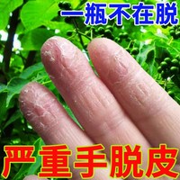 手脱皮药膏真菌感染手指，苗家x皮肤病，汗泡疱疹手裂口鹅掌风特效药