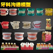 牙模型模具牙齿模型牙科教学模型可拆卸口腔假牙刷牙备牙模型树脂