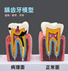 牙科口腔诊所龋齿蛀牙病理，牙解剖模型牙齿，模型刷牙教学模型幼儿园