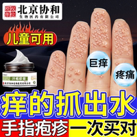 北京协和手指汗疱疹儿童，可用
