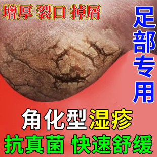 角化型湿疹足癣脚癣一次净专治脚裂后跟干裂修复霜脱皮真菌感染zy