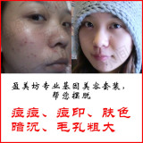 黄钻买家力荐！痘痘，痘印全不见，只留细腻光滑蛋白肌