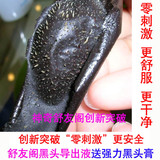 黑头导出液 一次就拨光黑头白头黄头