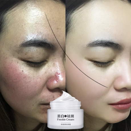 雀斑特效产品